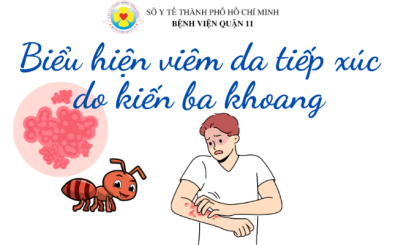 (HCDC) Biểu hiện viêm da tiếp xúc do kiến ba khoang
